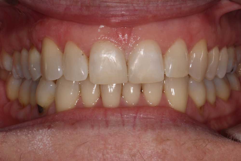 white fillings closing a tooth gap  markethill