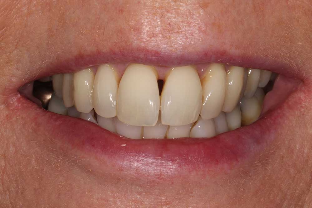 Straightened smile after using clear ceramic braces  markethill