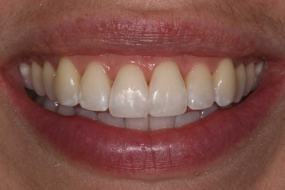 Straight smile provided by Paul Reaney using ceramic braces  markethill