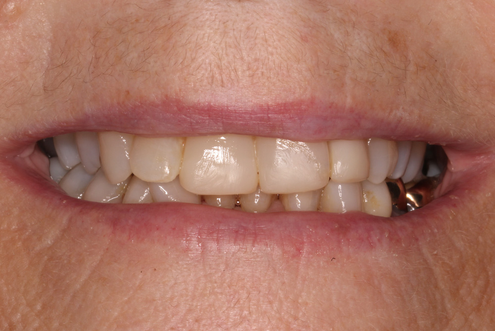  treatment by Paul Reaney adult braces armagh
