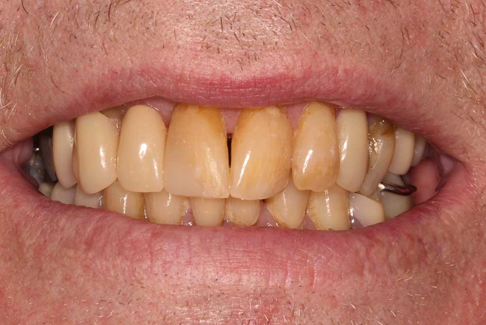  treatment by Paul Reaney adult braces armagh