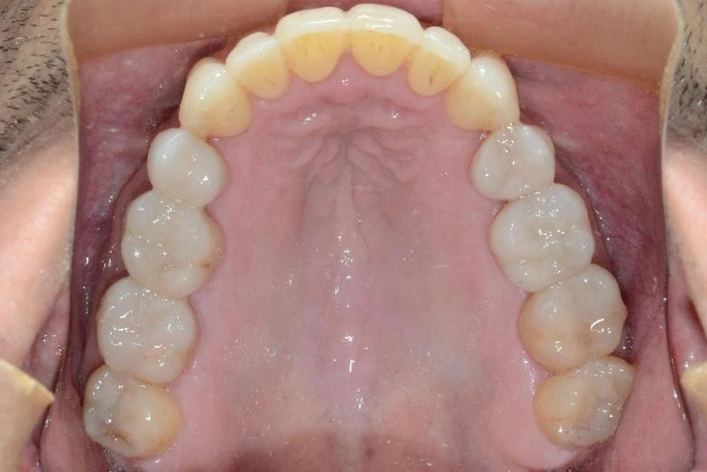 invisalign treatment and  white fillings - after with Paul Reaney