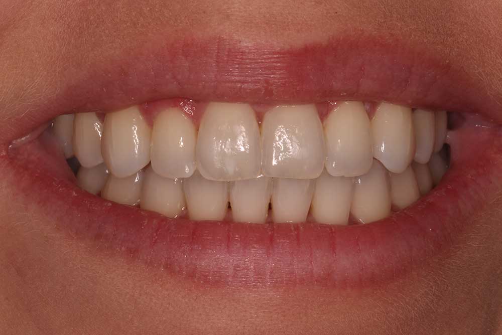 invisalign treatment after From Paul Reaney near Portadown