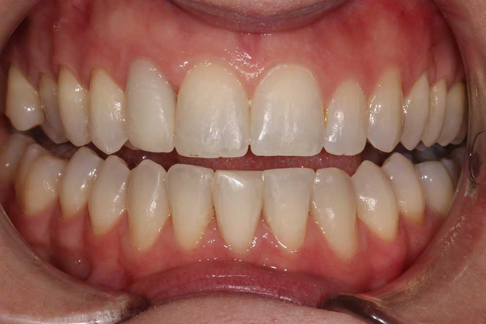 Beautiful smile after using adult braces armagh