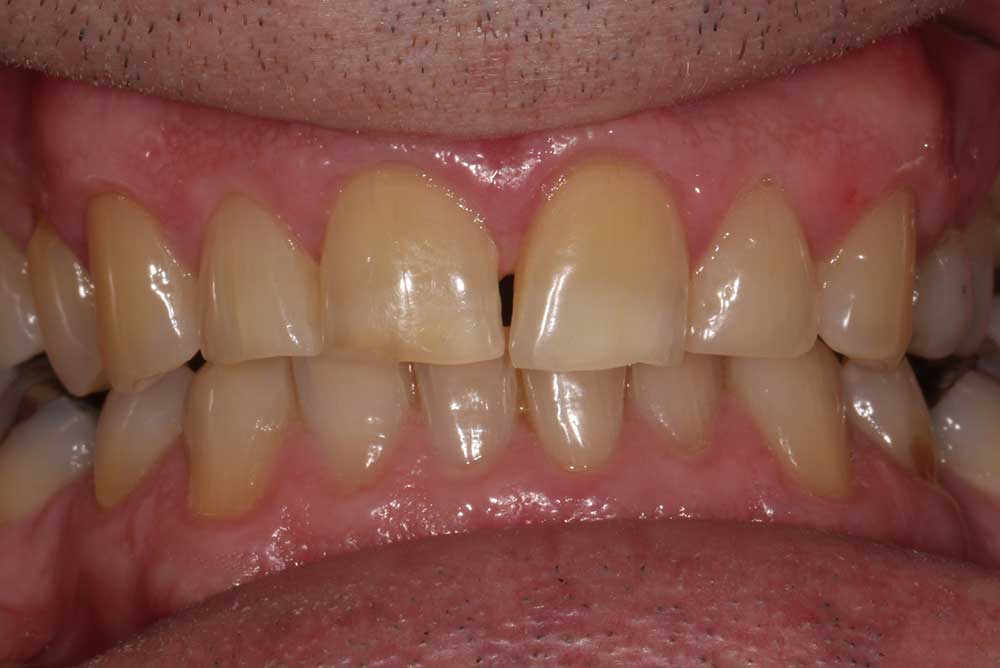 Patients mouth with stained uneven teeth, northern ireland