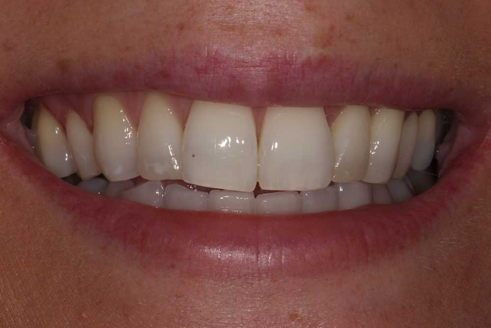 PAtients teeth with uneven edges,northern ireland