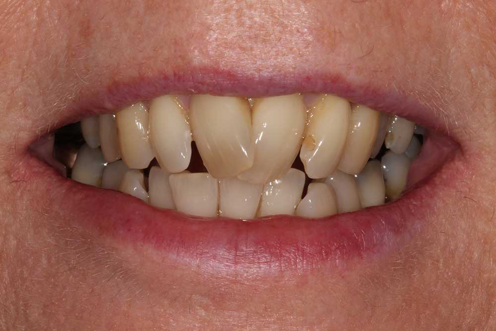 PAtient with crossed front teeth before braces northern ireland