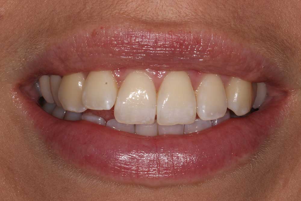 Woman with projecting tooth before orthodontics northern ireland
