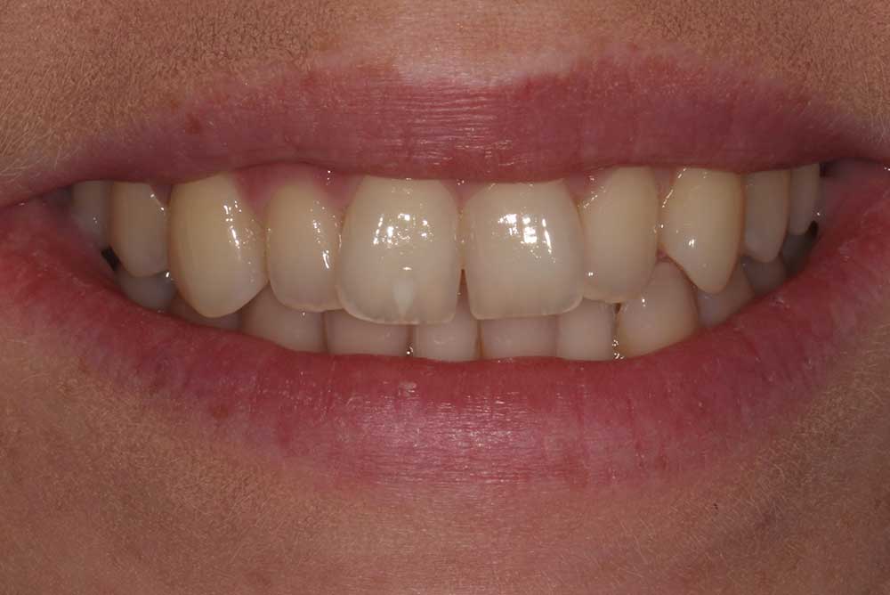 invisalign treatment before in northern ireland