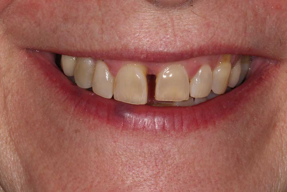 Older female patient with gap in front upper teeth beforeOrthodontics northern ireland