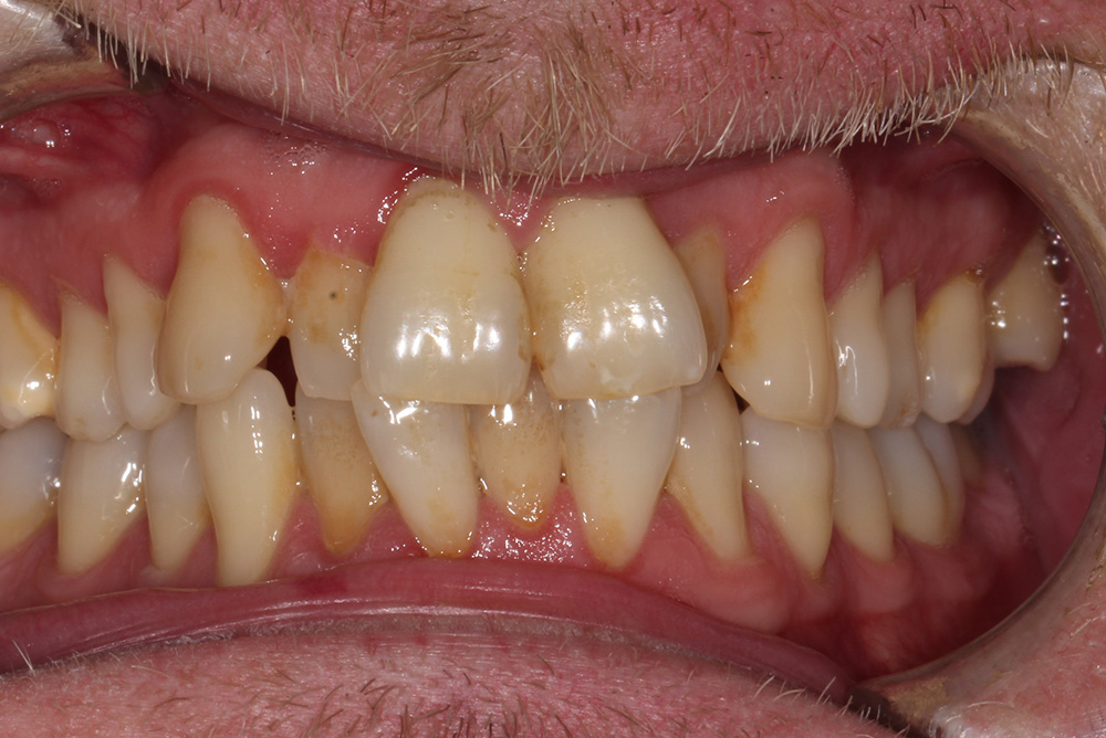 adult braces, tooth whitening and composite bonding