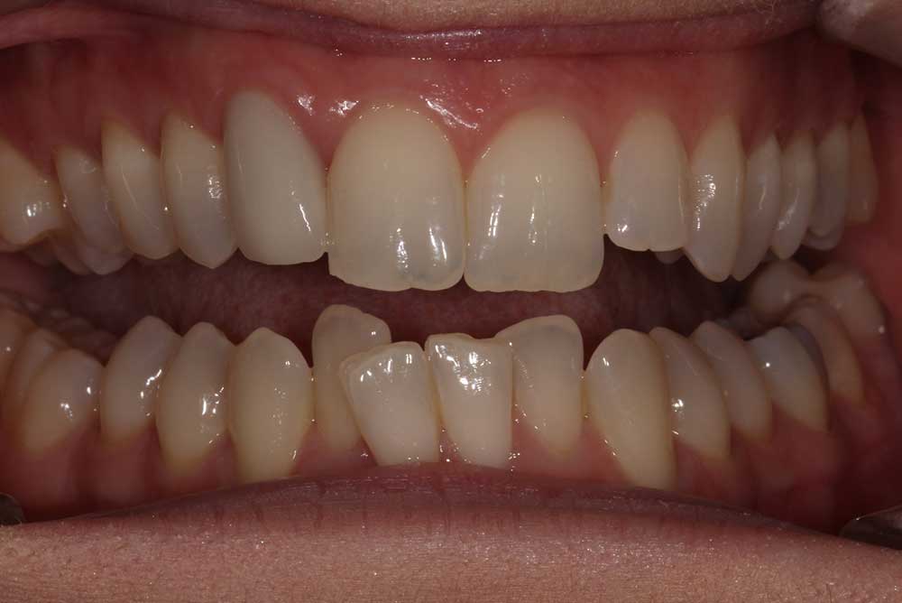 Patient with crooked teeth before Orthodontics and extraction northern ireland