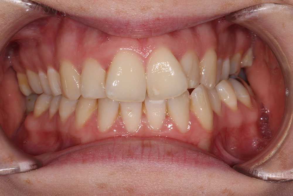 Patient's smile before cosmetic treatment with upper ceramic braces - Markethill