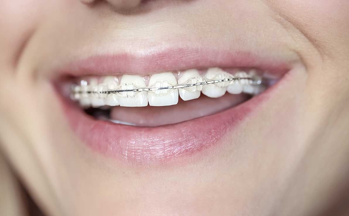 smile with clear braces fitted