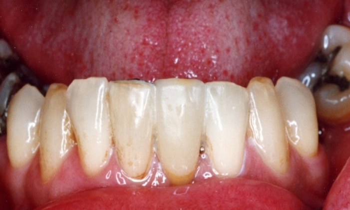 Teeth after gap has been bridged by Dentistry @ Markethill in armagh