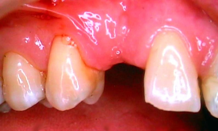 Gap in molars