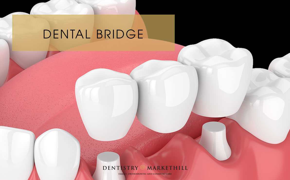 Drawing of dental bridge