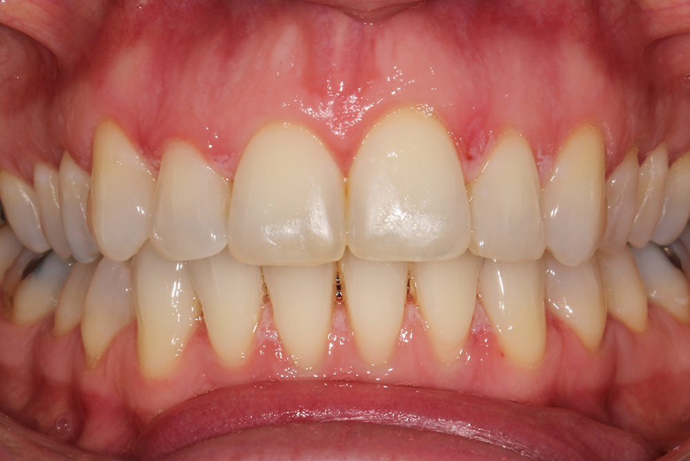 adult braces, tooth whitening and composite bonding