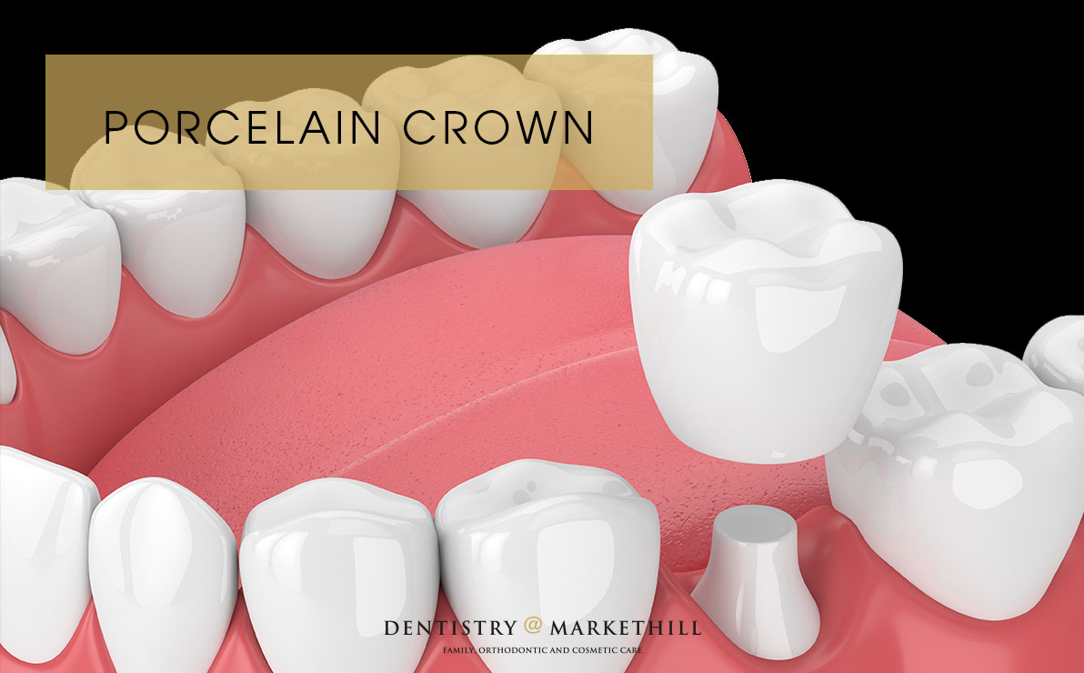 Drawing of how a porcelain crown sits in the mouth