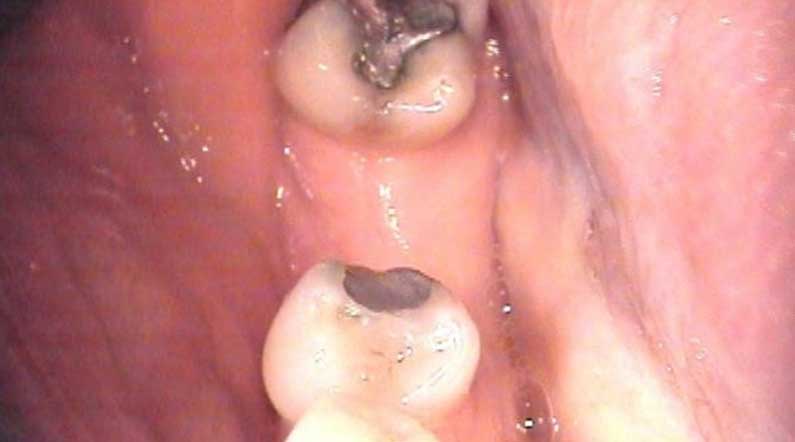 Gap in teeth before dental implants