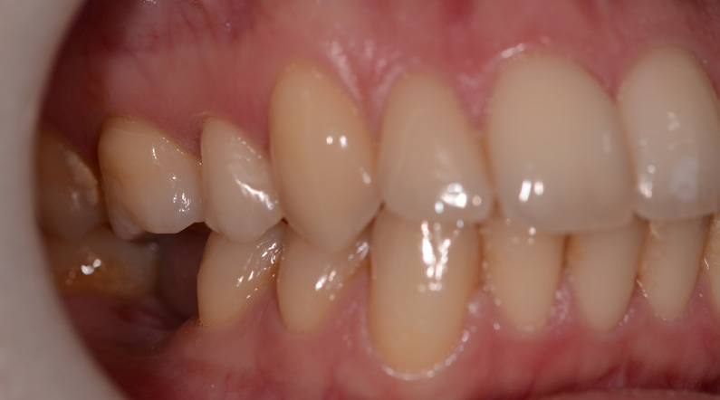 dental implants northern ireland