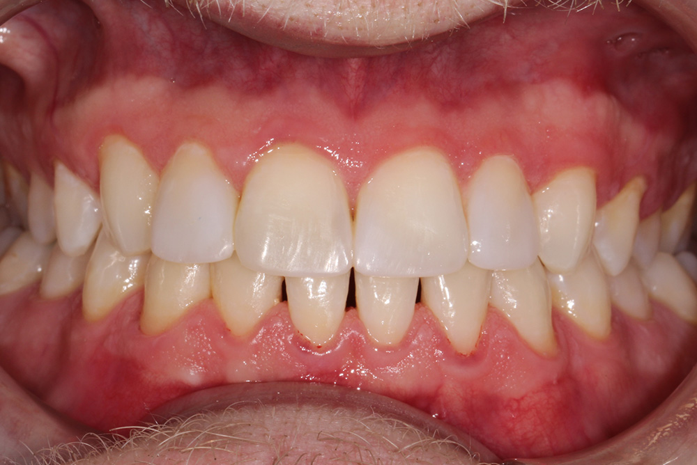 tooth whitening and composite bonding armagh