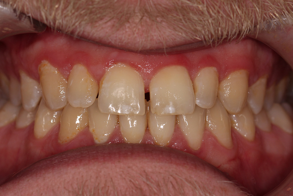 tooth whitening and composite bonding  northern ireland