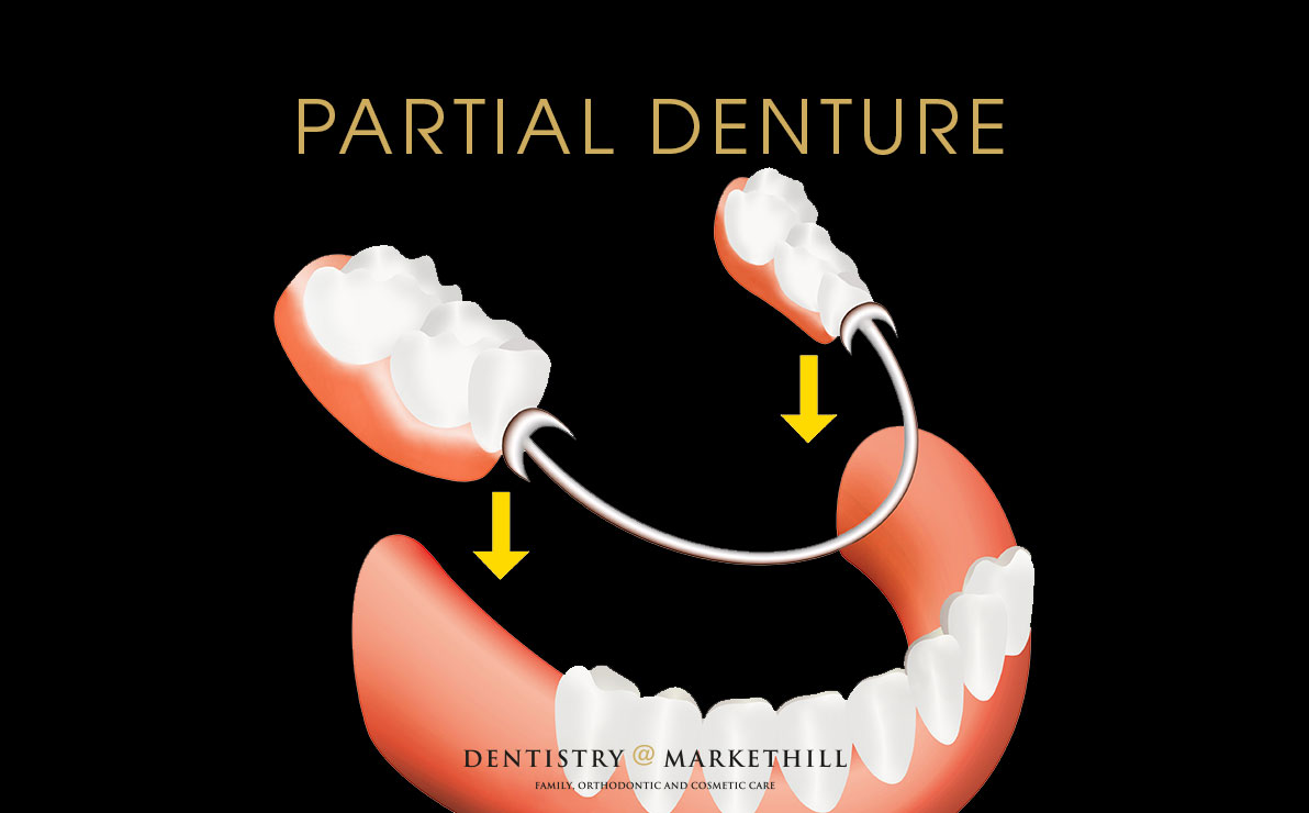 Drawing of partial denture replacing missing back lower teeth