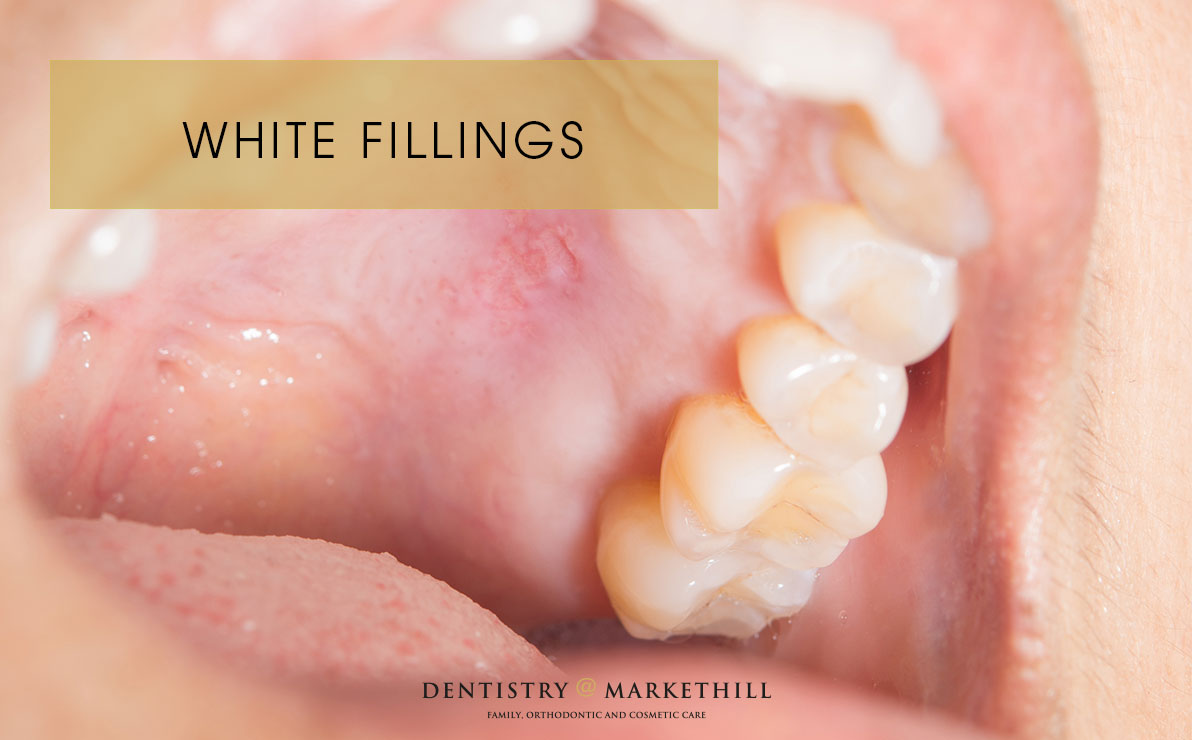 white fillings restoring broken teeth